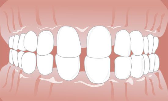Zahnlucken Kieferorthopadie Osnabruck Dr Mohrbutter
