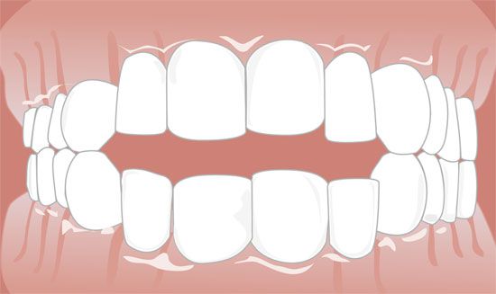 Offener Biss - Kieferorthopädie Osnabrück, Dr. Mohrbutter Offener Biss - Kieferorthopädie Osnabrück, Dr. Mohrbutter