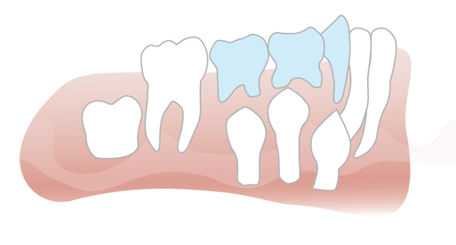 Zahnwechsel, Milchzähne, bleibende Zähne
